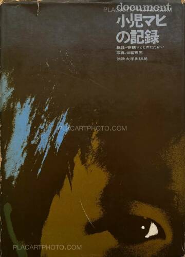 Tadao Mitome,Document : Shonimahi no kiroku / Document : Record of Infantile paralysis