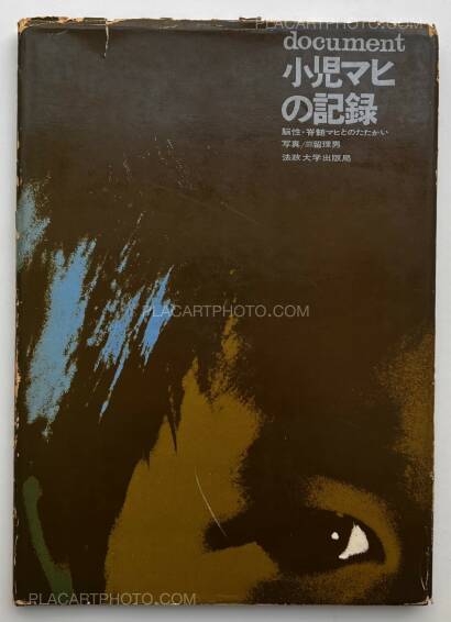Tadao Mitome,Document : Shonimahi no kiroku / Document : Record of Infantile paralysis